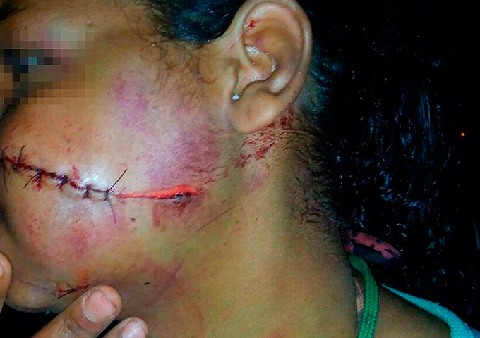 Mulher tem rosto 'rasgado' com faca por companheiro em briga