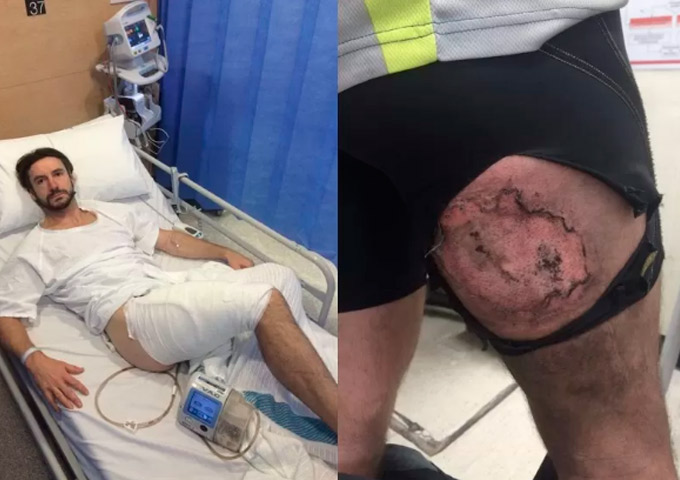 iPhone6 explode no bolso de ciclista e causa queimaduras graves
