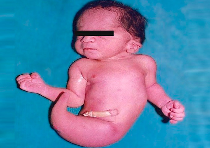 Mulher resolve abortar após descobrir que gerava 'bebê sereia'