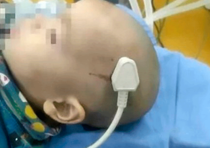 Menino cai da cama e tem o crânio perfurado por uma tomada