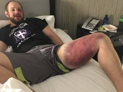 Lutador mostra 'estrago' na perna após luta contra brasileiro