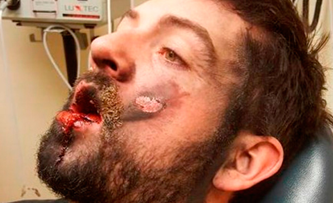 Homem perde sete dentes após cigarro eletrônico explodir