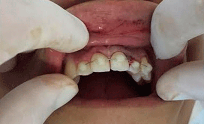 35 cirurgias de face já foram feitas em foliões do carnaval baiano