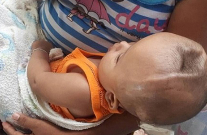 Bebê com buraco na cabeça é abandonado e corre risco de vida