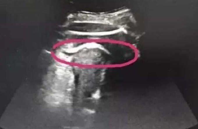 Mulher grávida quase morre após ‘chute’ do bebê romper o útero