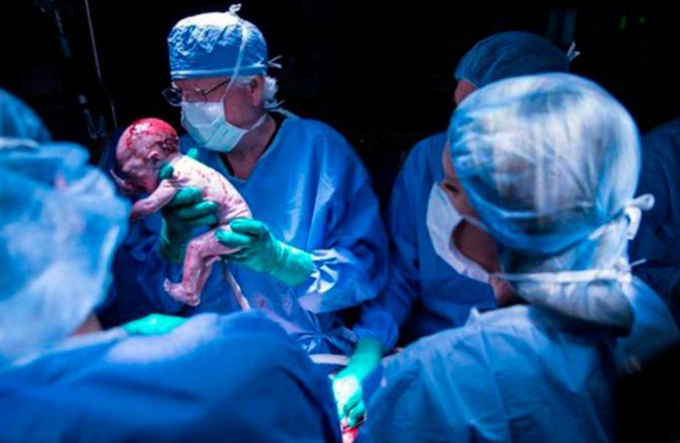 Pela primeira vez, mulher que fez transplante de útero dá à luz