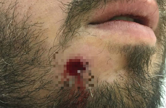 Homem é baleado no rosto e tira a bala com a mão