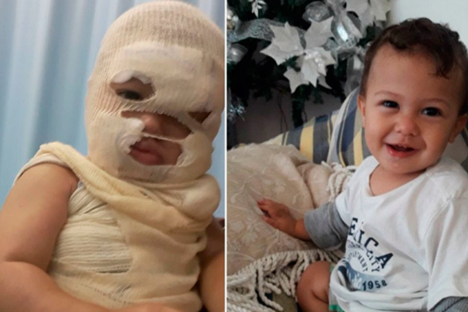Bebê fica com rosto desfigurado após sofrer acidente 