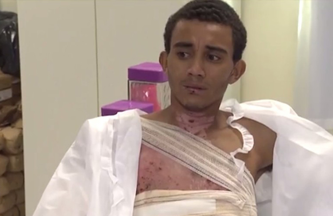 Jovem alega que teve 75% do corpo queimado pela namorada