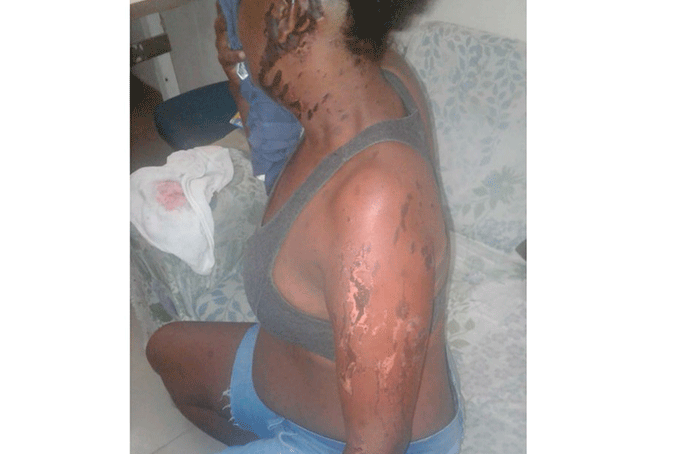 Mulher é atacada com ácido por ex-namorado após término 