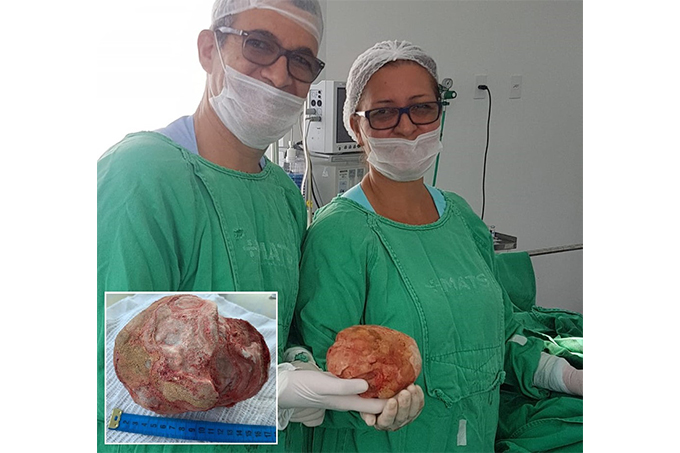 Lavrador de 51 anos tem pedra de 1,3 Kg retirada da bexiga 