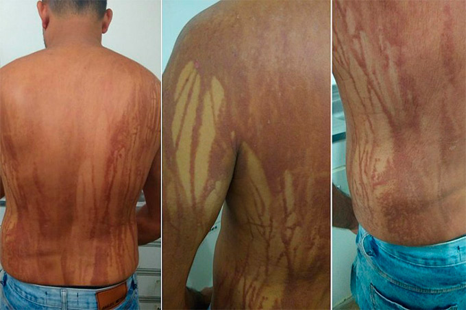 Turista com manchas na pele após banho de mar em Ilhéus piora e é internado