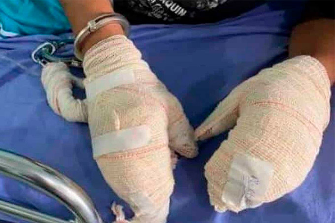 Detentos são internados com doença misteriosa que 'come' pele