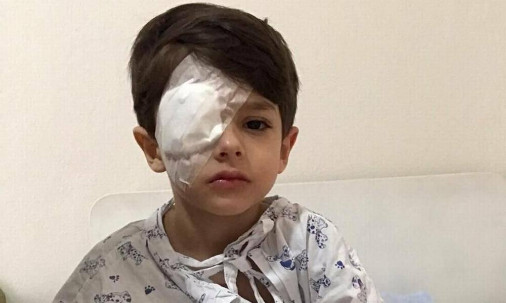 Criança tem córnea queimada após álcool em gel cair no olho 