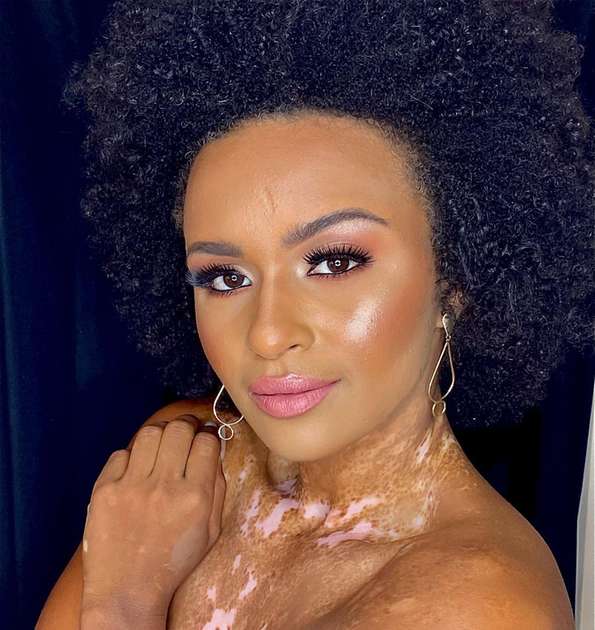 Equipe de Natália denuncia ataques racistas; ex-BBB foi chamada de 'dálmata' por ter vitiligo
