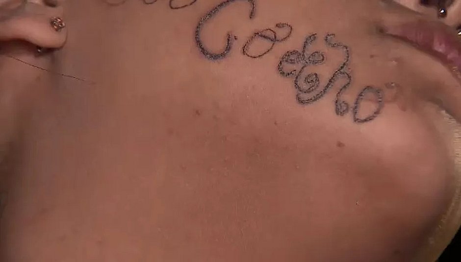 Jovem inicia remoção de tatuagem no rosto feita à força por ex: 'Me sinto livre'