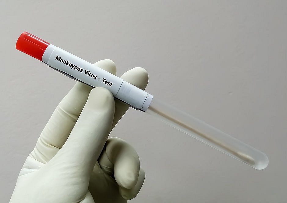 Salvador confirma caso de monkeypox em criança de 2 anos