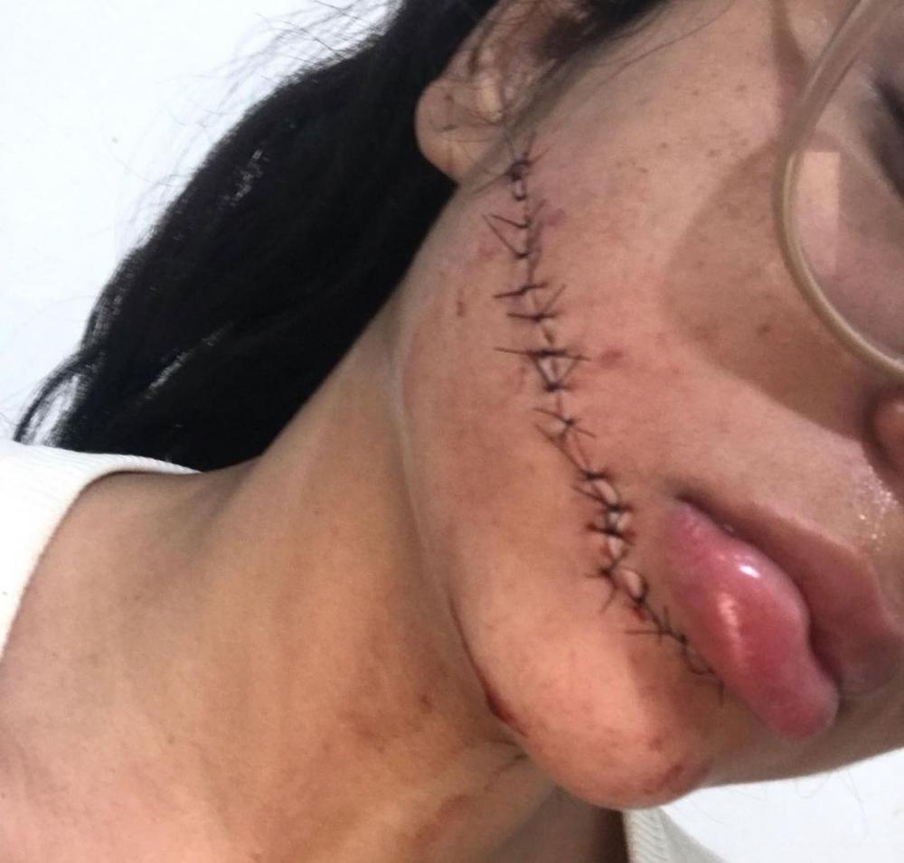 Jovem ferida no rosto dentro de ônibus fala sobre atentado no É do Povo