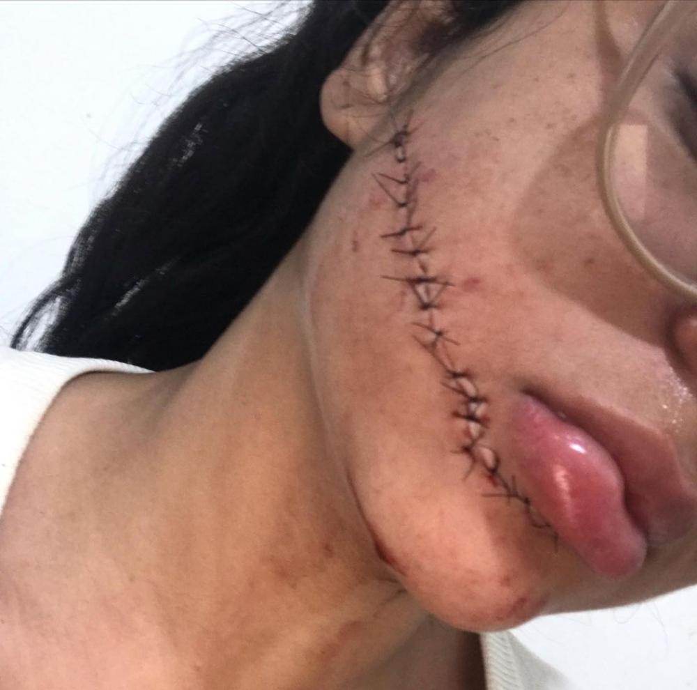 Laudo aponta lesão leve em jovem que levou 18 pontos no rosto; DPT pediu novo exame