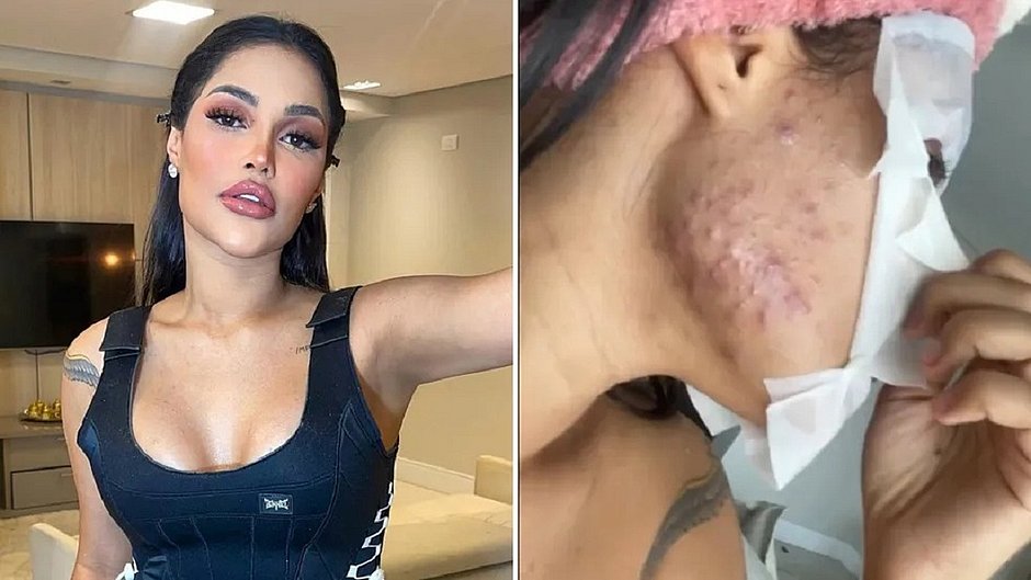 Ex-BBB Flay revela efeitos colaterais do 'chip da beleza': 'Ganhei 10 kg'