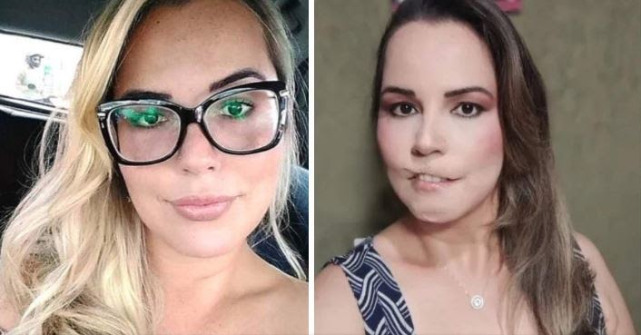 Mulher perde o lábio superior após harmonização facial: “Tristeza e raiva”