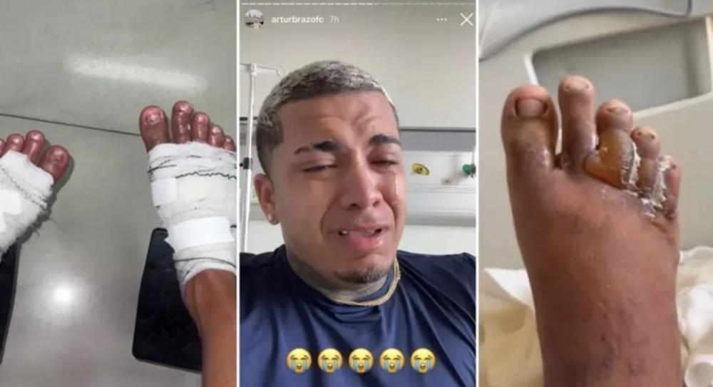 Influencers quase amputam pés após queimaduras com gelo