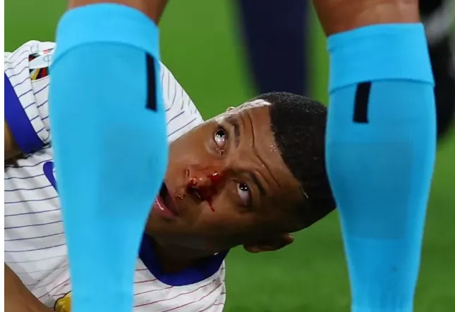 Mbappé tem fratura, e França avalia se cirurgia é necessária