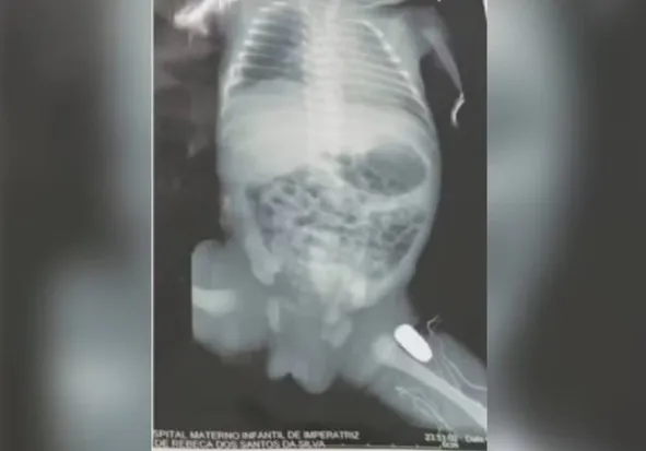 Bebê baleada na barriga da mãe passa por cirurgia para retirar bala