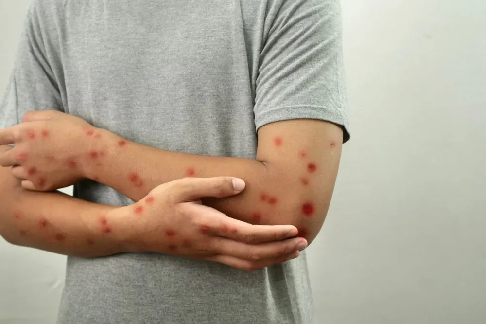 Bahia é o quarto estado com mais casos de mpox