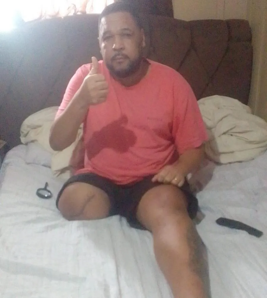 Morador de Mata faz vaquinha virtual para compra de prótese ortopédica 