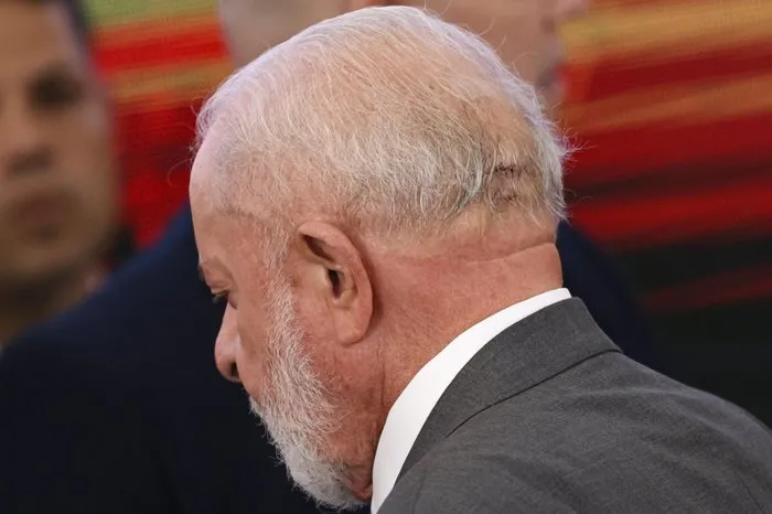 Lula fará novo procedimento para bloquear sangramento no cérebro, diz boletim