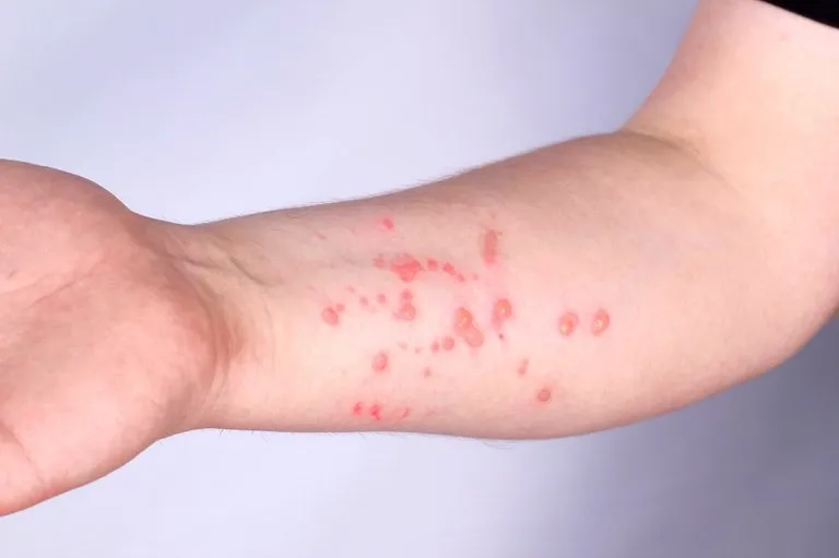 Região Norte do Brasil registra casos de mpox