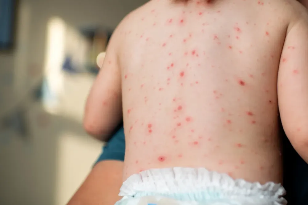 Número de casos de catapora aumenta na Bahia e especialista alerta que tendência é de crescimento