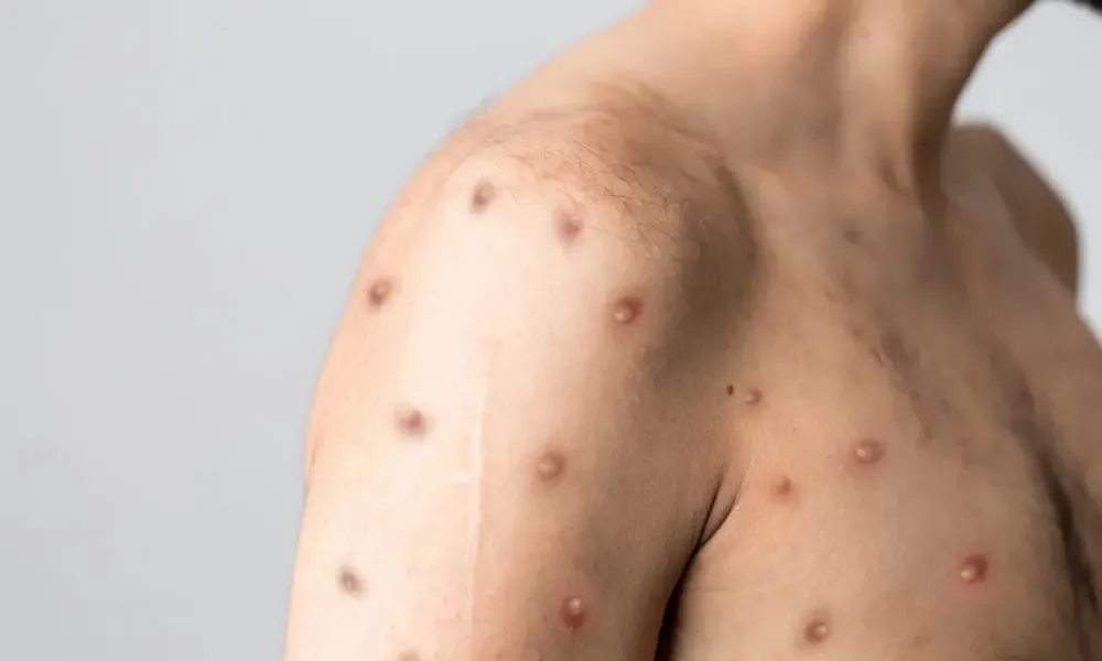 Bahia confirma dois casos de Mpox, um deles em Salvador