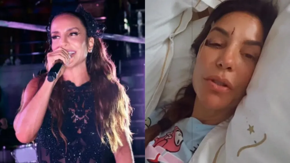 Ivete Sangalo surge com rosto ferido após internação e explica estado de saúde