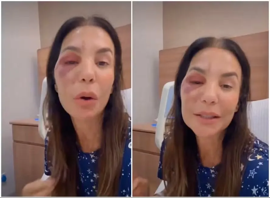 Ivete Sangalo fala sobre cirurgia no rosto após queda: “Quebrei dois ossos”