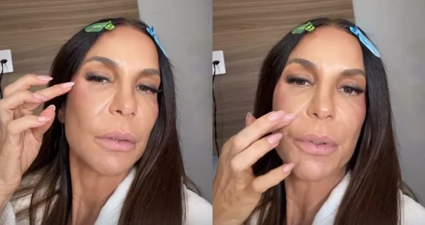Ivete Sangalo revela sequela após cirurgia e revela que colocou presilhas de titânio no rosto