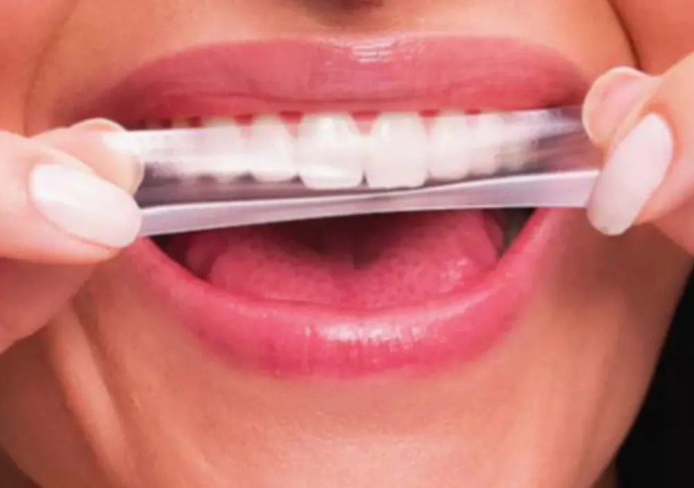 Anvisa proíbe venda de fitas de clareamento dental divulgadas nas redes sociais