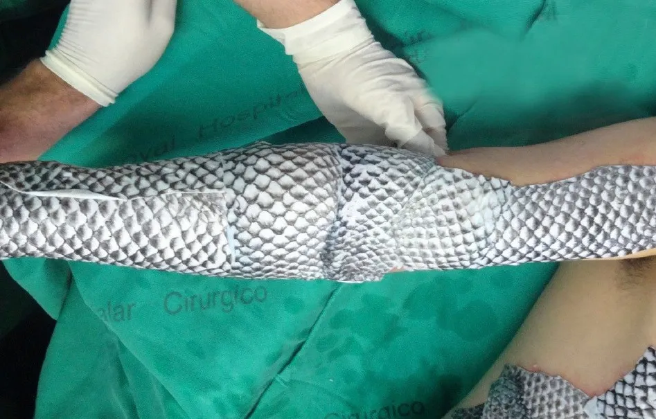 Curativo de Tilápia: entenda como pele de peixe está tratando feridas